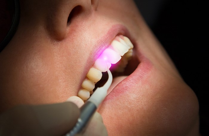 The Advantages of Laser Periodontal Therapy for Treating Gum Disease