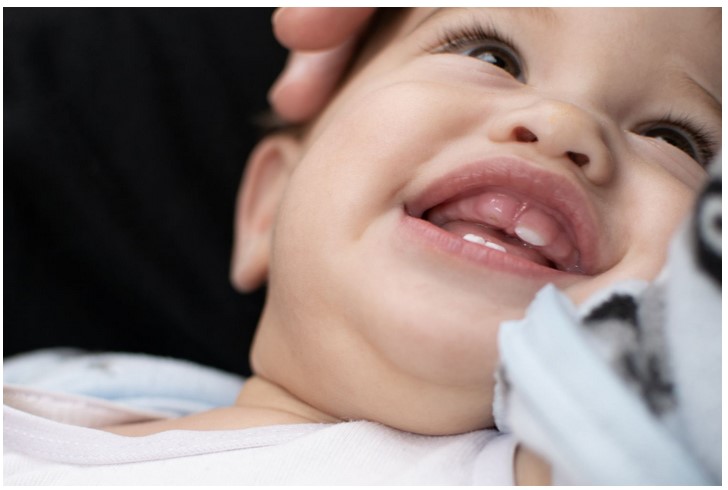 Normal Top Lip Tie in Newborns: Recognizing Typical Lip Tie Patterns