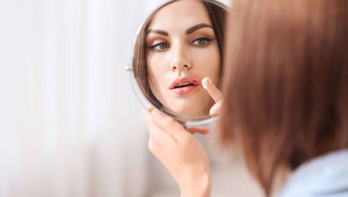 Best Cold Sore Treatment: Over-the-Counter and Home-Based Solutions for Oral Herpes Relief