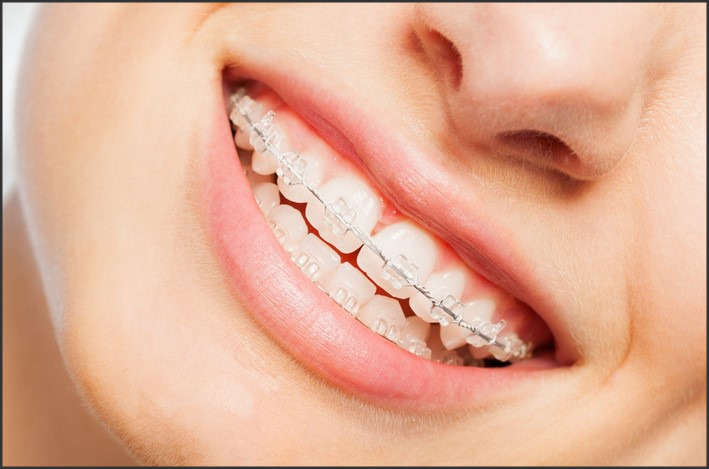 Clear Brackets with Colored Bands: Personalizing Your Orthodontic Treatment