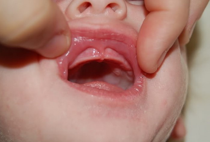 Lip Tie Surgery: What to Expect and When It’s Necessary