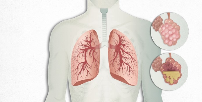 Stage 3 COPD: Symptoms, Treatment, and Quality of Life