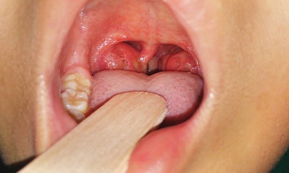White Spots in the Back of the Throat: Causes and Remedies