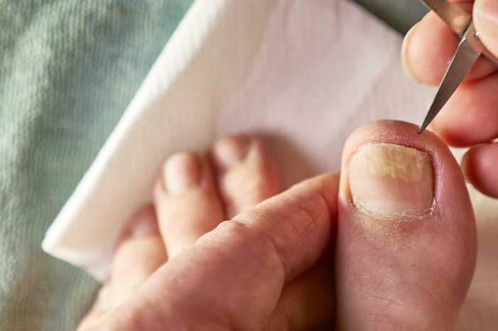 Dark Colored Toenails: Common Causes and Treatment Tips
