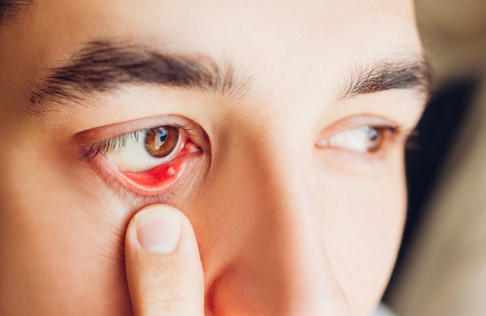 Eye Drops for Meibomian Gland Dysfunction (MGD): Relief and Care