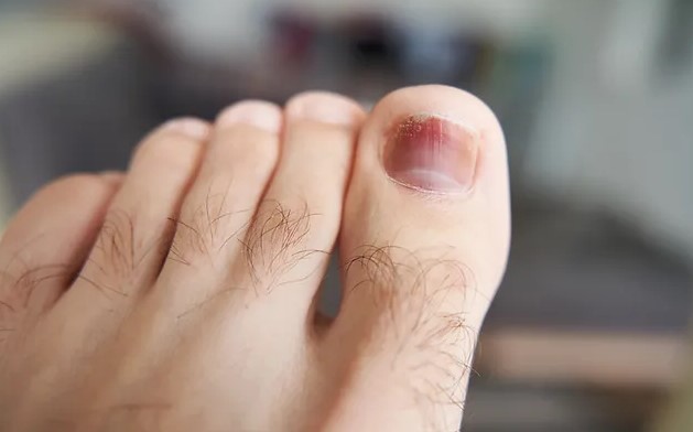 Dealing with a Bruised Toenail: Causes, Symptoms, and Home Care