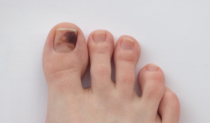 Dealing with a Dark Spot Under the Toenail: Causes and Treatment