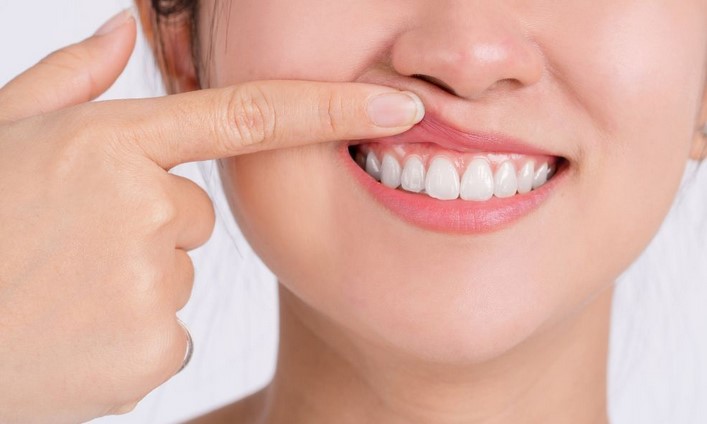 Recession of Gums: Causes, Prevention, and Treatment Options