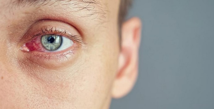 Eye Herpes Home Treatment: Remedies for Ocular Herpes Relief