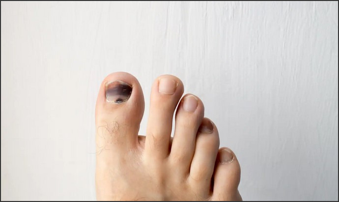 Black Spot on Nail: Possible Causes and Nail Health Tips