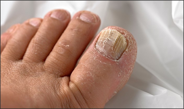 Yellow Spots on Toenails: Possible Causes and Treatments