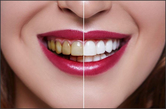 Teeth Whitening by the Dentist: Professional Options and Costs